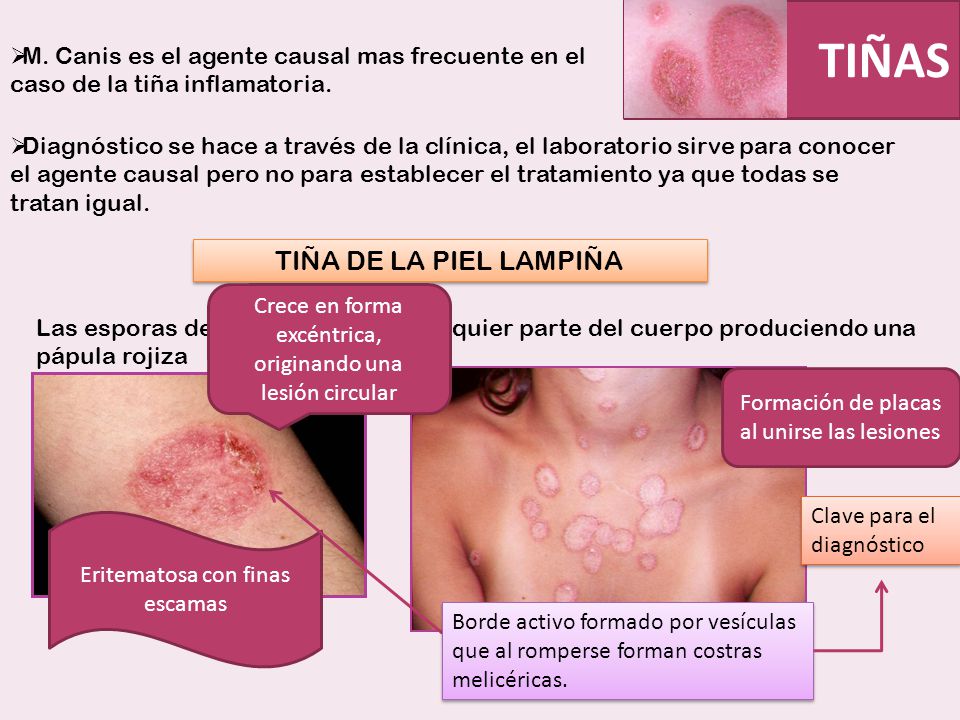 El tratamiento de la uña encarnada en novomoskovske